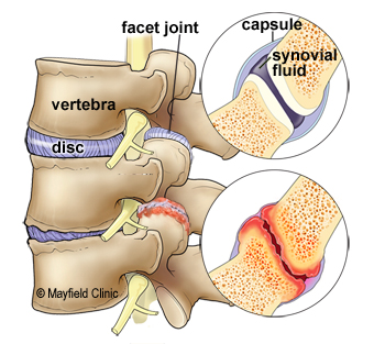 Facet Joint Syndrome