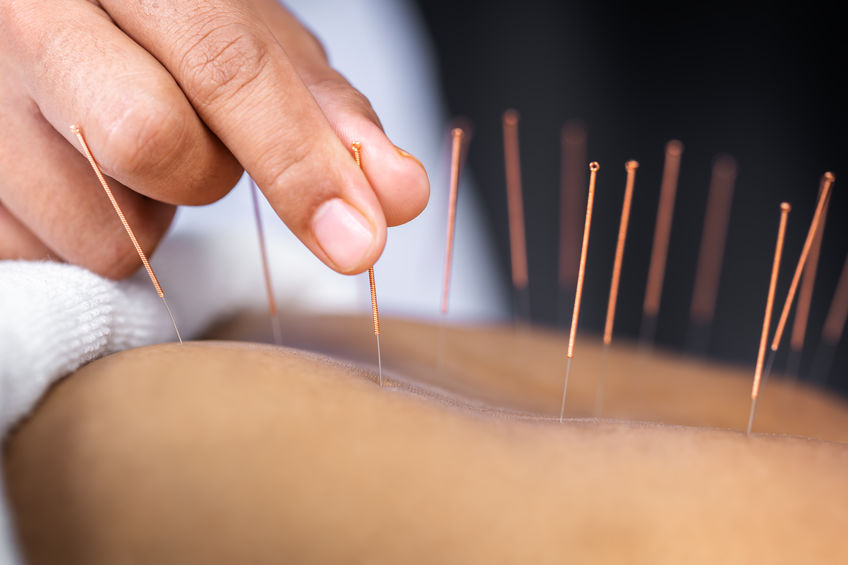 Registered acupuncturist providing acupuncture treatment in Barrie at MyoDynamic Health